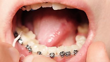 2nd day in braces - dental floss - close up mouth tour